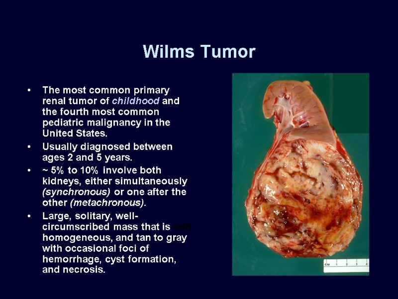 Wilms Tumor The most common primary renal tumor of childhood and the fourth most
